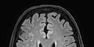 Study: Small-scale, clinical study offers early hope for developing a treatment — (Details)