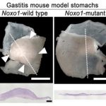 Study: How inflammation causes gastric cancer — (Details)