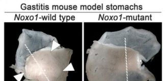 Study: How inflammation causes gastric cancer — (Details)