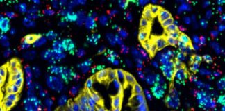 Study: Researchers discover a potential therapeutic target for deadly cancer — (Details)