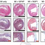 Study: Heart patch could limit muscle damage in heart attack aftermath — (Details)