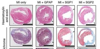 Study: Heart patch could limit muscle damage in heart attack aftermath — (Details)