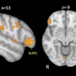 Study: Behavioral disorders in kids with autism linked to reduced brain connectivity — (Details)