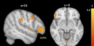 Study: Behavioral disorders in kids with autism linked to reduced brain connectivity — (Details)