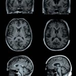 Study: Obesity linked with differences in form and structure of the brain — (Details)