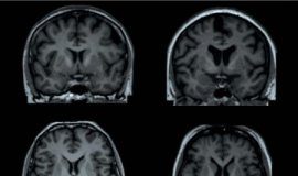 Study: Obesity linked with differences in form and structure of the brain — (Details)