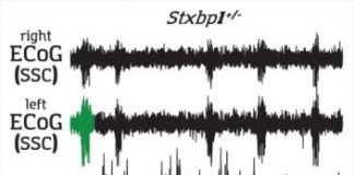 Study: Trigger region found for absence epileptic seizures — (Details)