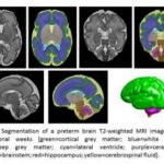 Study: Early lipids boost brain growth for vulnerable micro-preemies — (Details)