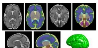 Study: Early lipids boost brain growth for vulnerable micro-preemies — (Details)