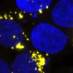 Study: Self-propagating amyloid and tau prions found in post-mortem brain samples, with highest levels in patients who died young — (Details)