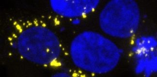 Study: Self-propagating amyloid and tau prions found in post-mortem brain samples, with highest levels in patients who died young — (Details)