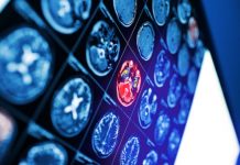 Offbeat: Brain imaging study finds negative implicit biases against individuals with scars, birthmarks and other facial differences —