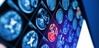 Offbeat: Brain imaging study finds negative implicit biases against individuals with scars, birthmarks and other facial differences —