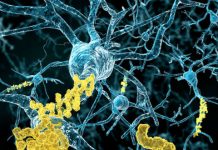 Research: An alternate theory for what causes Alzheimer’s disease —