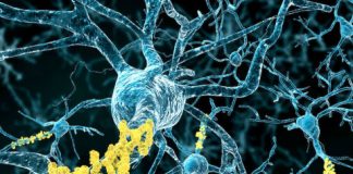 Research: An alternate theory for what causes Alzheimer’s disease —