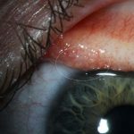 Report: Parasitic worms found in woman’s eye in California Report: Parasitic worms found in woman's eye in California