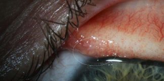 Report: Parasitic worms found in woman’s eye in California Report: Parasitic worms found in woman's eye in California