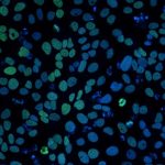 New study targets stem cells that drive aggressive blood cancer New study targets stem cells that drive aggressive blood cancer