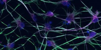 Study: Stem cell technology offers new insight into MND Study: Stem cell technology offers new insight into MND