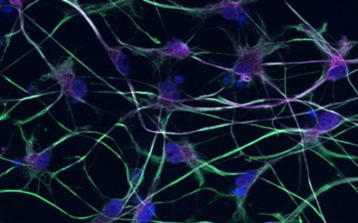 Study: Stem cell technology offers new insight into MND