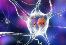 Stem cell study finds malfunctioning brain cells in patients who were diagnosed before age 50, scientists test potential new treatment Stem cell study finds malfunctioning brain cells in patients who were diagnosed before age 50, scientists test potential new treatment