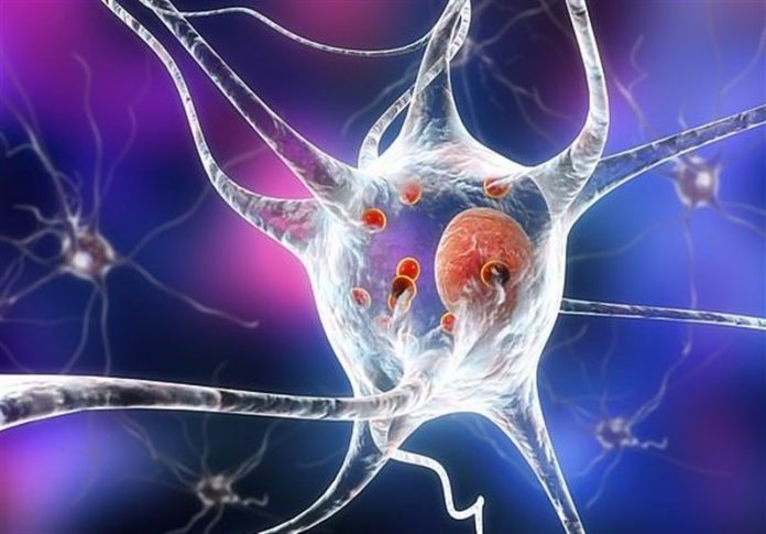 Stem cell study finds malfunctioning brain cells in patients who were diagnosed before age 50, scientists test potential new treatment Stem cell study finds malfunctioning brain cells in patients who were diagnosed before age 50, scientists test potential new treatment