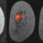 Study: Magnetised molecules used to monitor breast cancer Study: Magnetised molecules used to monitor breast cancer