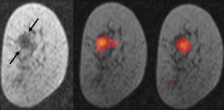 Study: Magnetised molecules used to monitor breast cancer Study: Magnetised molecules used to monitor breast cancer
