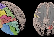 Whole genome sequencing reveals genetic structural secrets of schizophrenia (Study) Whole genome sequencing reveals genetic structural secrets of schizophrenia (Study)