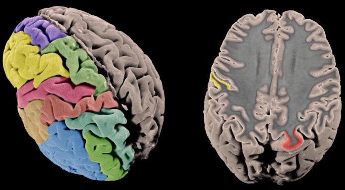 Whole genome sequencing reveals genetic structural secrets of schizophrenia (Study)