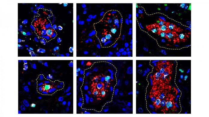 Clues to COVID-19 complications come from NET-like inflammatory response