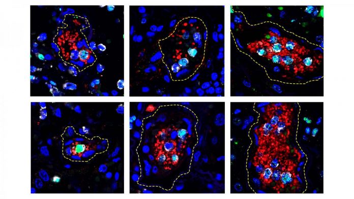 New evidence for how blood clots may form in very ill COVID-19 patients