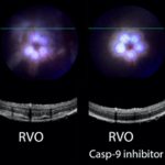New eye drops may prevent a common cause of blindness New eye drops may prevent a common cause of blindness