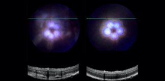 New eye drops may prevent a common cause of blindness New eye drops may prevent a common cause of blindness