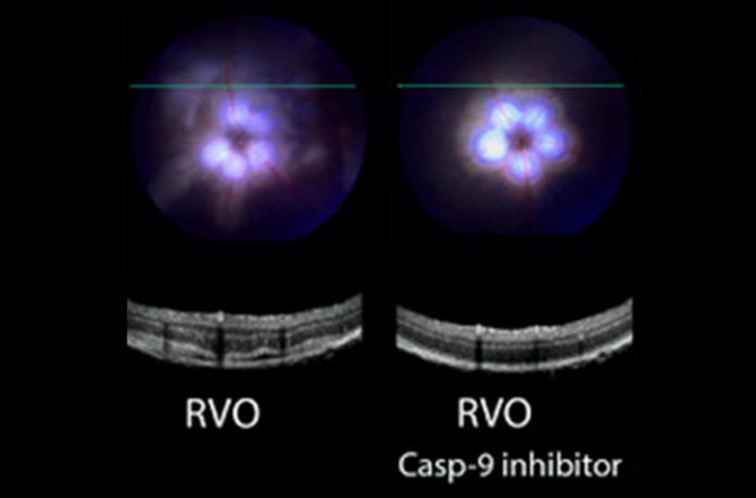 New eye drops may prevent a common cause of blindness