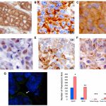 Oncotarget: IQGAP1 control of centrosome function defines variants of breast cancer Oncotarget: IQGAP1 control of centrosome function defines variants of breast cancer