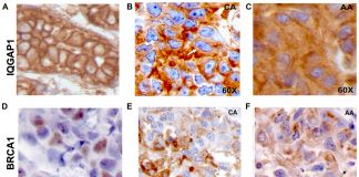 Oncotarget: IQGAP1 control of centrosome function defines variants of breast cancer Oncotarget: IQGAP1 control of centrosome function defines variants of breast cancer