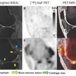 Report: Novel bone imaging approach provides insights into the progression of knee osteoarthritis Novel bone imaging approach provides insights into the progression of knee osteoarthritis