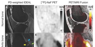 Report: Novel bone imaging approach provides insights into the progression of knee osteoarthritis Novel bone imaging approach provides insights into the progression of knee osteoarthritis