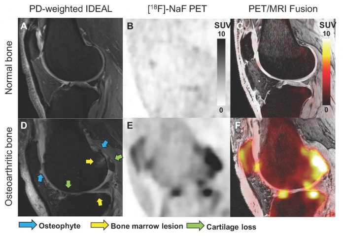 Novel bone imaging approach provides insights into the progression of knee osteoarthritis