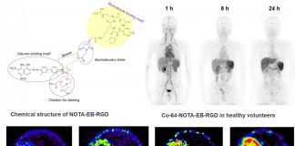 Report: New PET radiotracer proven safe and effective in imaging malignant brain tumors New PET radiotracer proven safe and effective in imaging malignant brain tumors