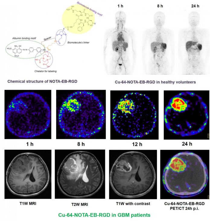 New PET radiotracer proven safe and effective in imaging malignant brain tumors