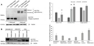Report: Oncotarget: The Golgi protein TMEM165 controls migration/invasion for carcinoma Oncotarget: The Golgi protein TMEM165 controls migration/invasion for carcinoma