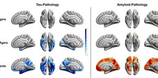 Report: SNMMI Image of the Year: Super-agers show resistance to tau and amyloid accumulation SNMMI Image of the Year: Super-agers show resistance to tau and amyloid accumulation
