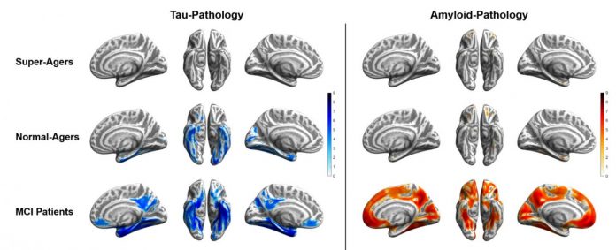 SNMMI Image of the Year: Super-agers show resistance to tau and amyloid accumulation