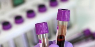 Alzheimer’s blood tests show new promise, says new research Alzheimer's blood tests show new promise, says new research