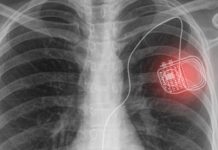 Tech: A novel active photonic wireless system to power medical implants A novel active photonic wireless system to power medical implants