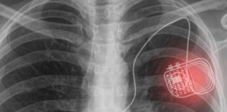 Tech: A novel active photonic wireless system to power medical implants A novel active photonic wireless system to power medical implants