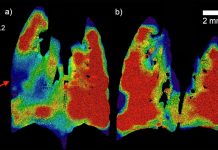 Tech: World-first technology breathes new life into cystic fibrosis detection and treatment World-first technology breathes new life into cystic fibrosis detection and treatment