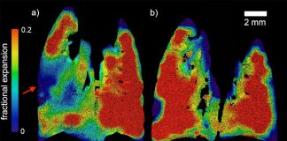 Tech: World-first technology breathes new life into cystic fibrosis detection and treatment World-first technology breathes new life into cystic fibrosis detection and treatment